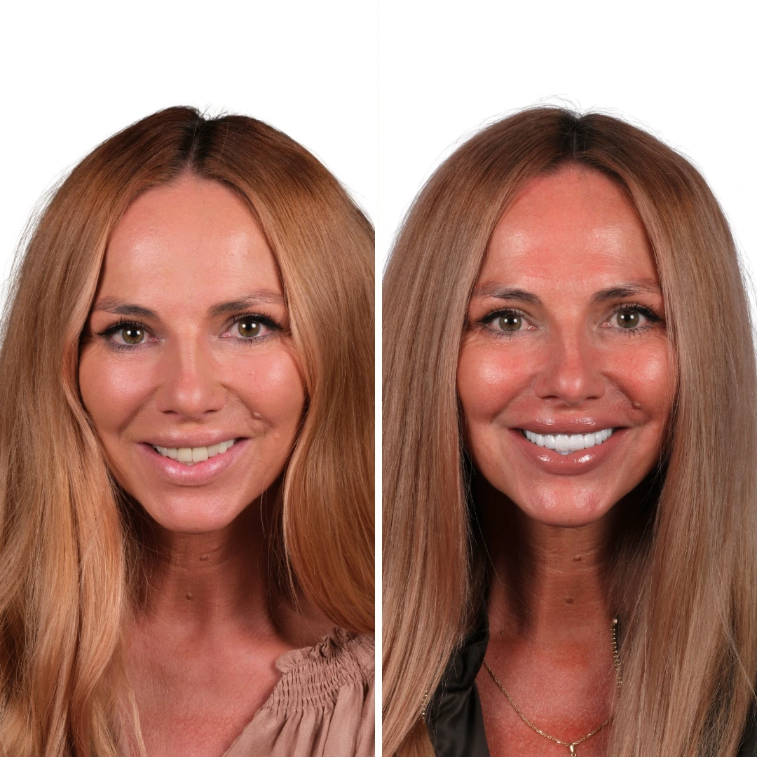 Before After from Antalya Unique Smile Turkey Dental Clinic