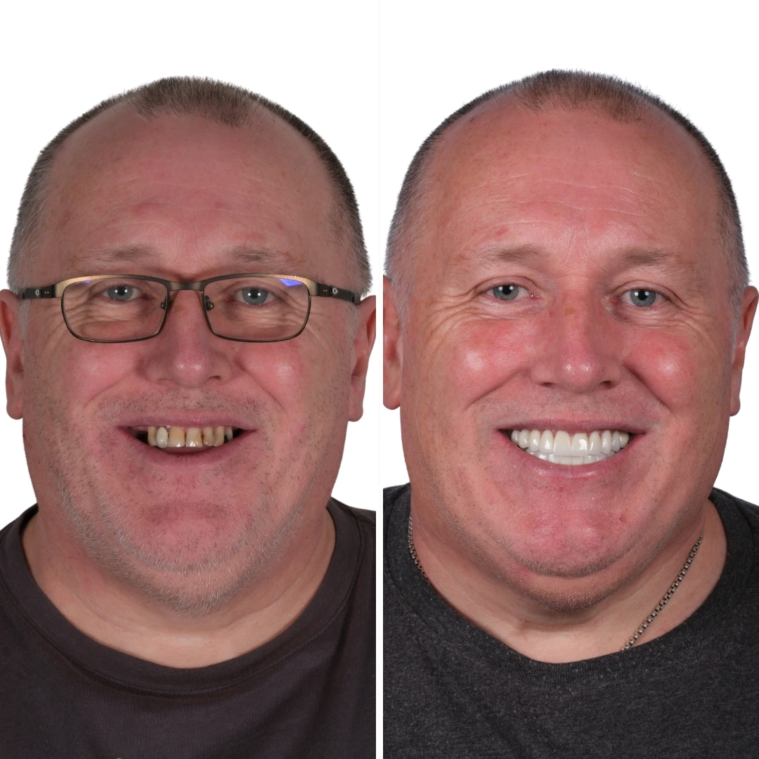 Before After from Antalya Unique Smile Turkey Dental Clinic