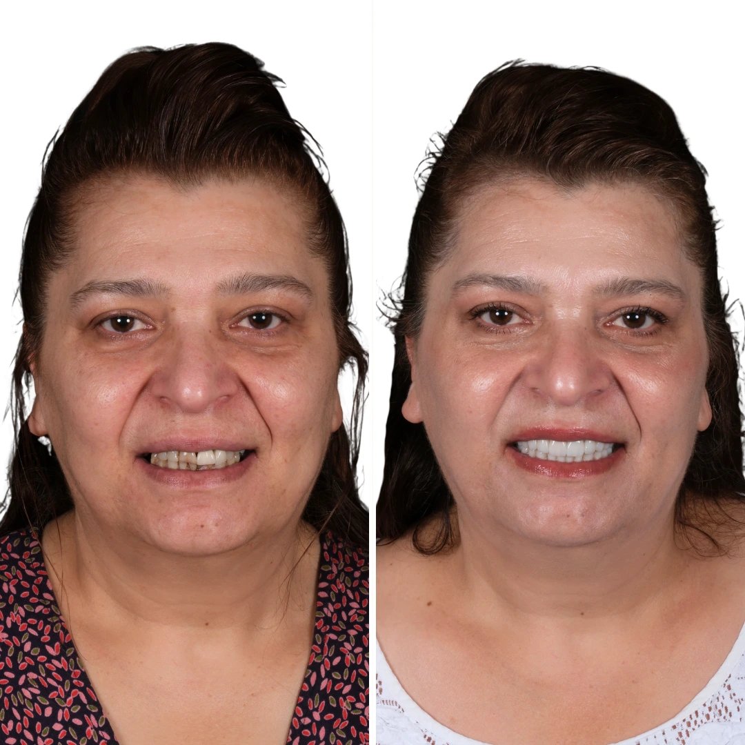 Before After from Antalya Unique Smile Turkey Dental Clinic