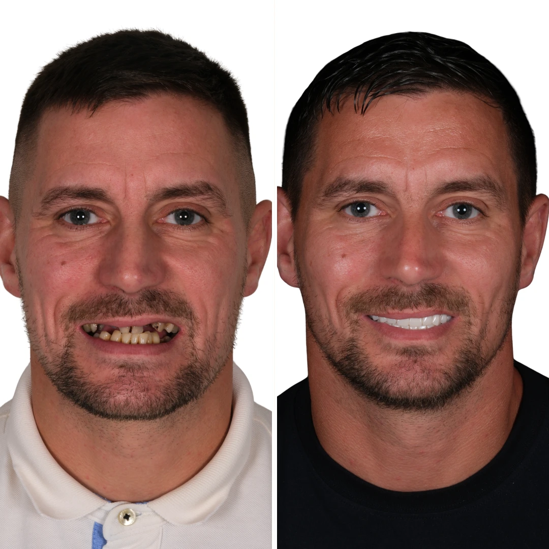 Before After from Antalya Unique Smile Turkey Dental Clinic