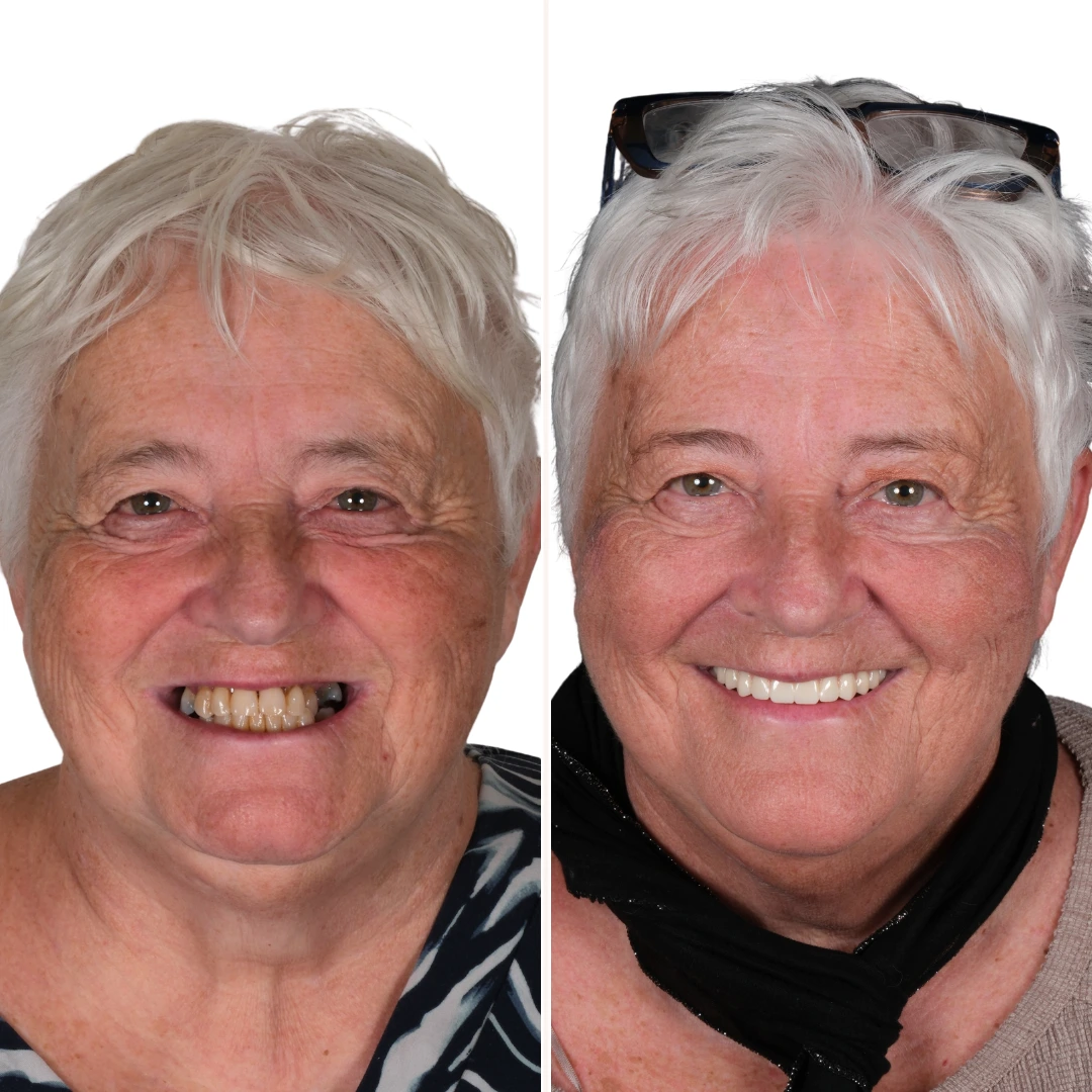 Before After from Antalya Unique Smile Turkey Dental Clinic