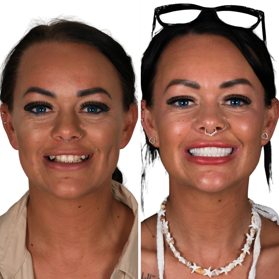 Before After from Antalya Unique Smile Turkey Dental Clinic