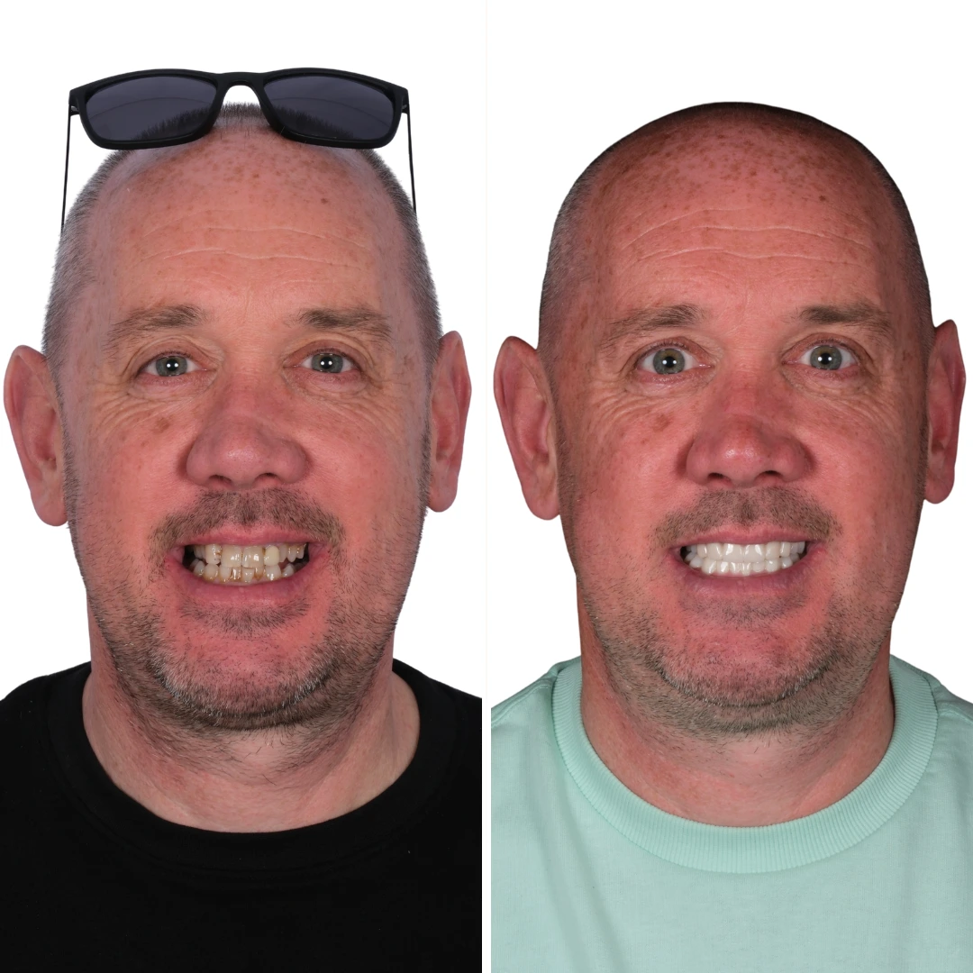 Before After from Antalya Unique Smile Turkey Dental Clinic