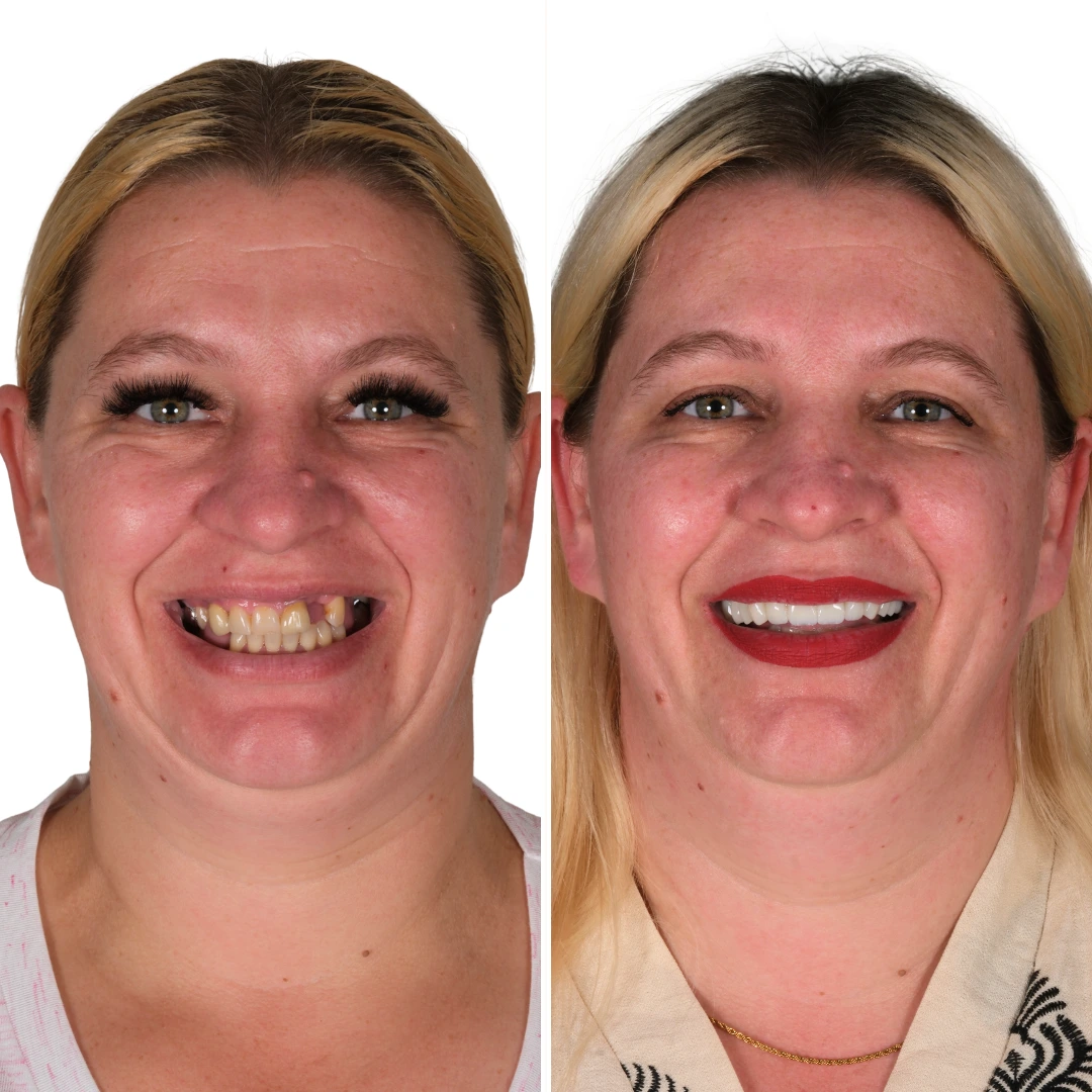 Before After from Antalya Unique Smile Turkey Dental Clinic