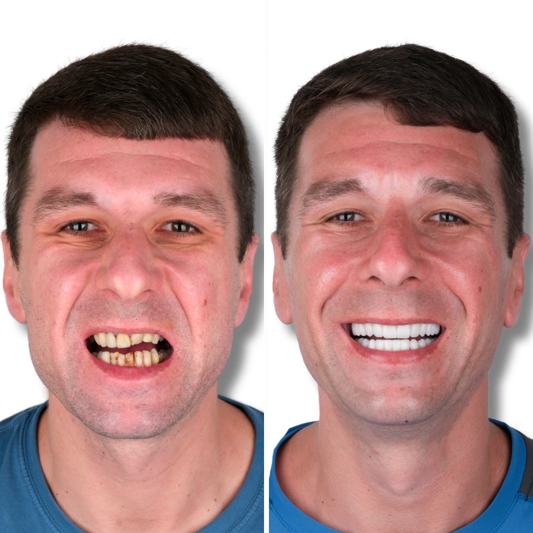 Before After from Antalya Unique Smile Turkey Dental Clinic
