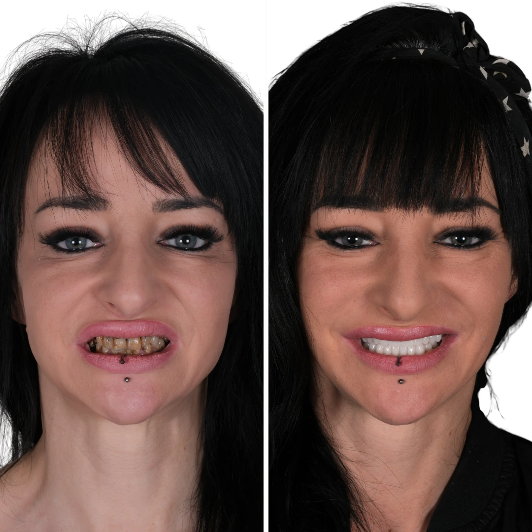 Before After from Antalya Unique Smile Turkey Dental Clinic