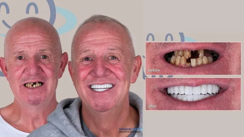 All on 4 dental implants prices in Antalya