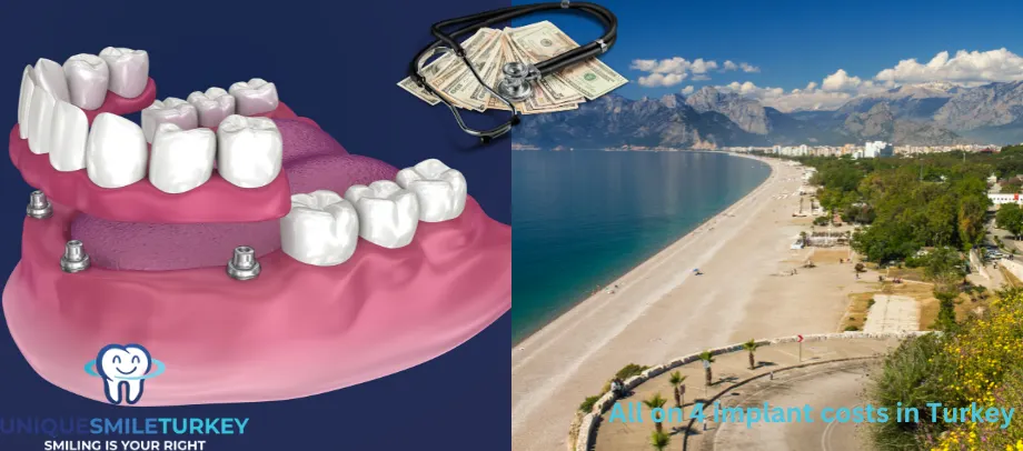 All on 4 dental implant costs in Turkey
