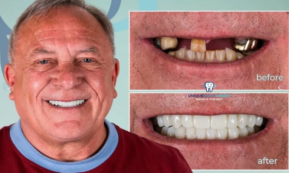 Dental implant Antalya