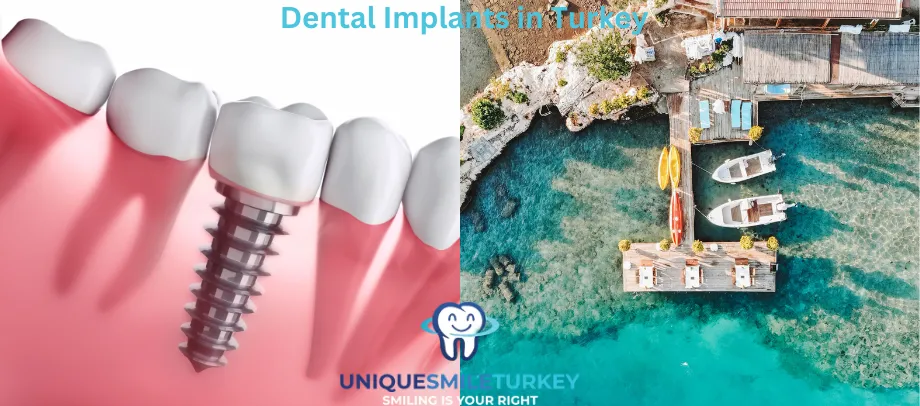 Dental Implants in Turkey