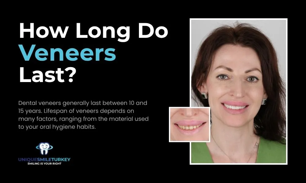 How long do veneers last?