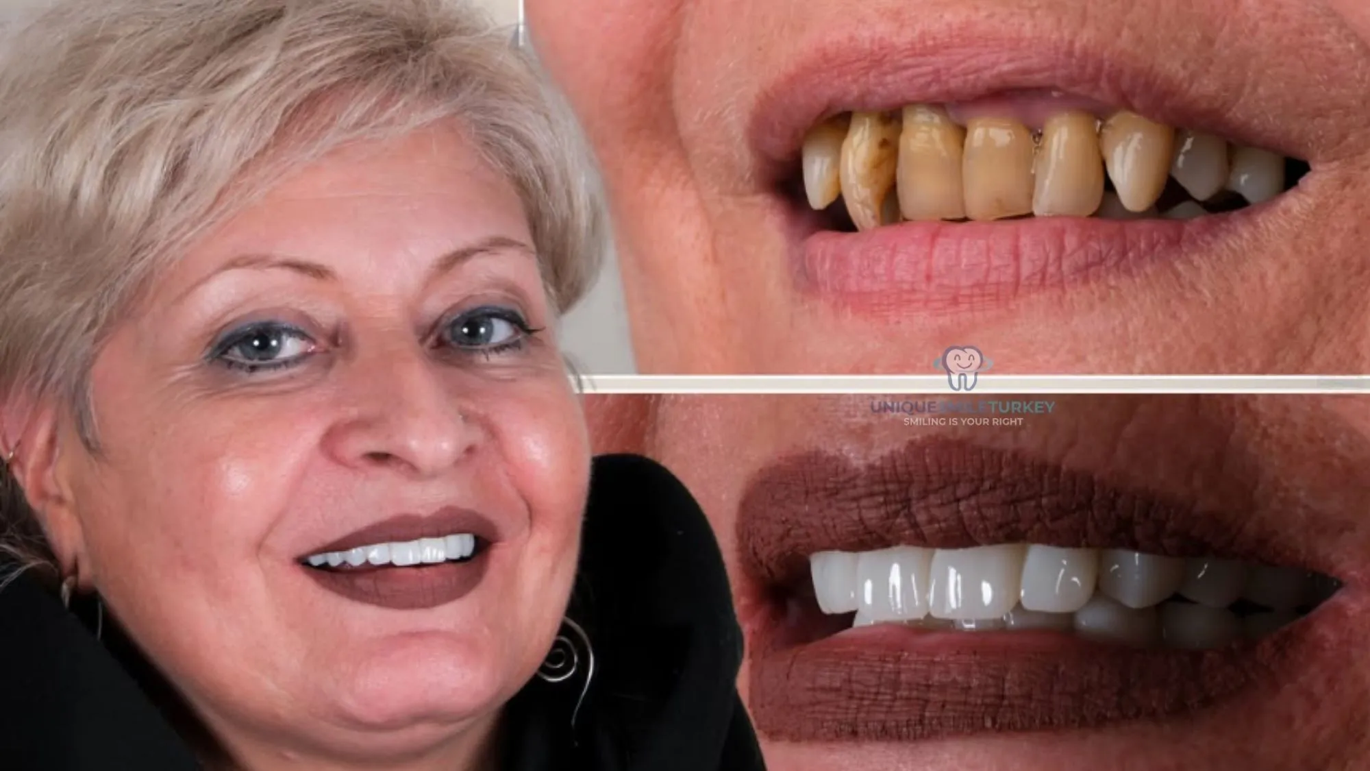 Emax veneers