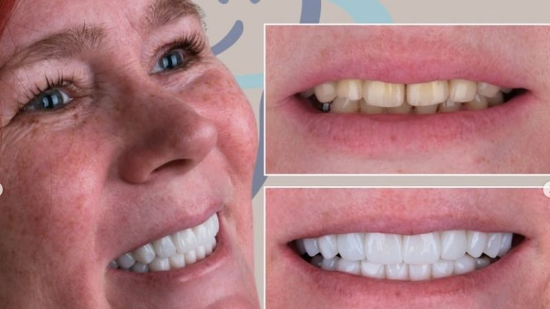 Emax vs zirconia veneers