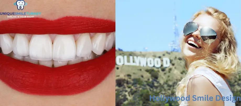 hollywood smile design