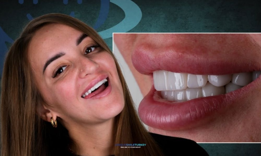 Porzellan Veneers Antalta