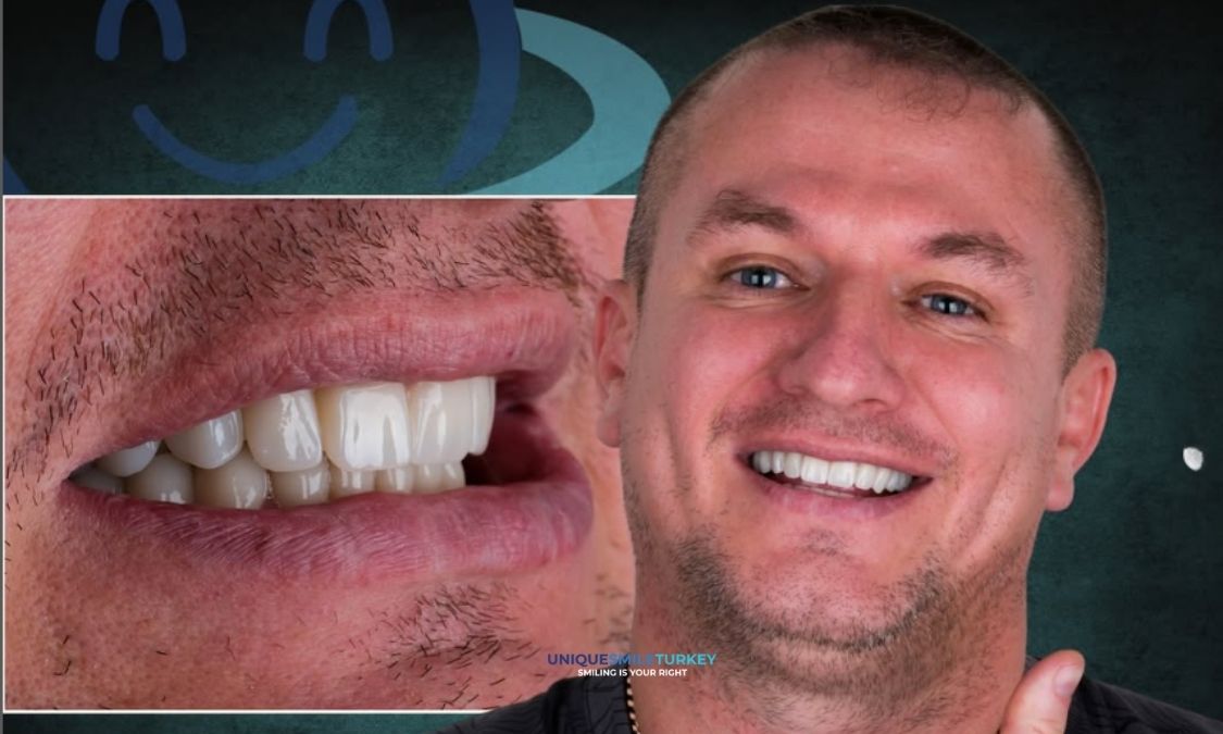 Porzellan-Laminat-Veneers Antalya