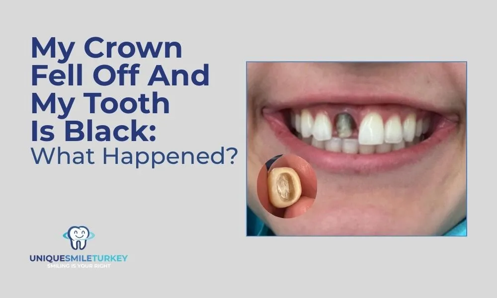 My Crown Fell Off And My Tooth Is Black