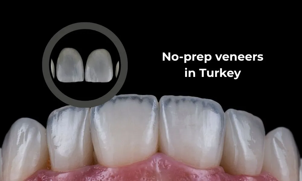 No prep veneers
