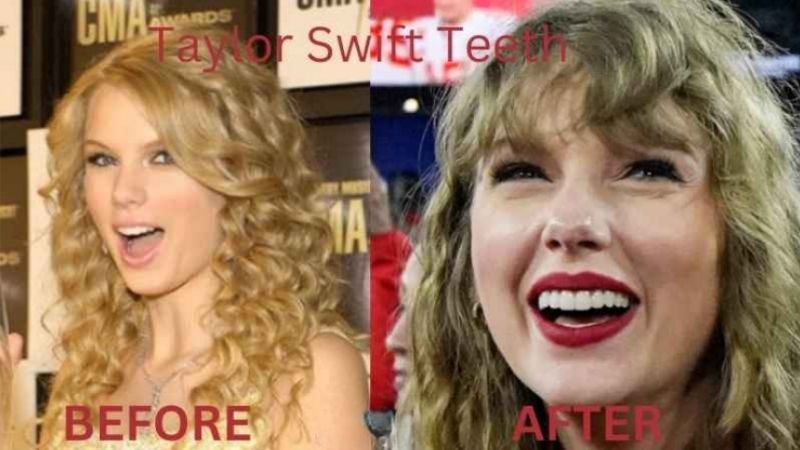 Taylor Swift Teeth Turkey
