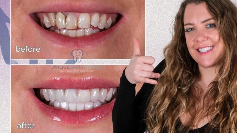 Teeth Bonding vs Veneers