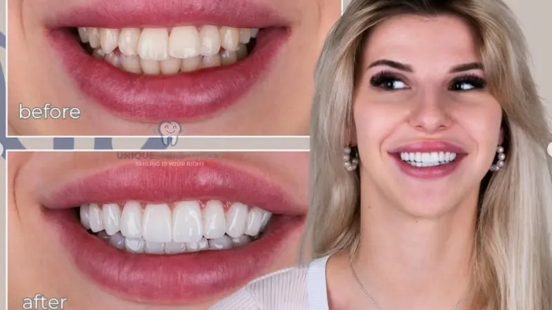 Veneer teeth in Turkey