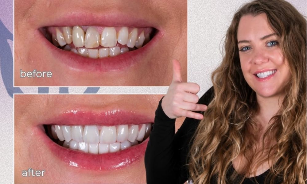 Emax vs zirconia Turkey