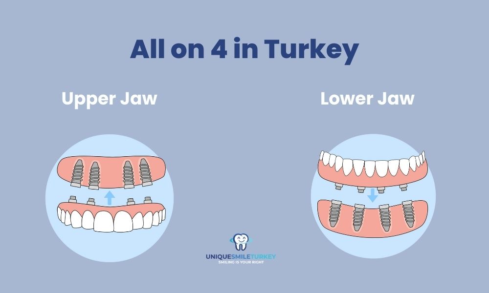 Upper jaw All on 4 dental implants