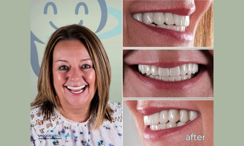 Dental crown photos