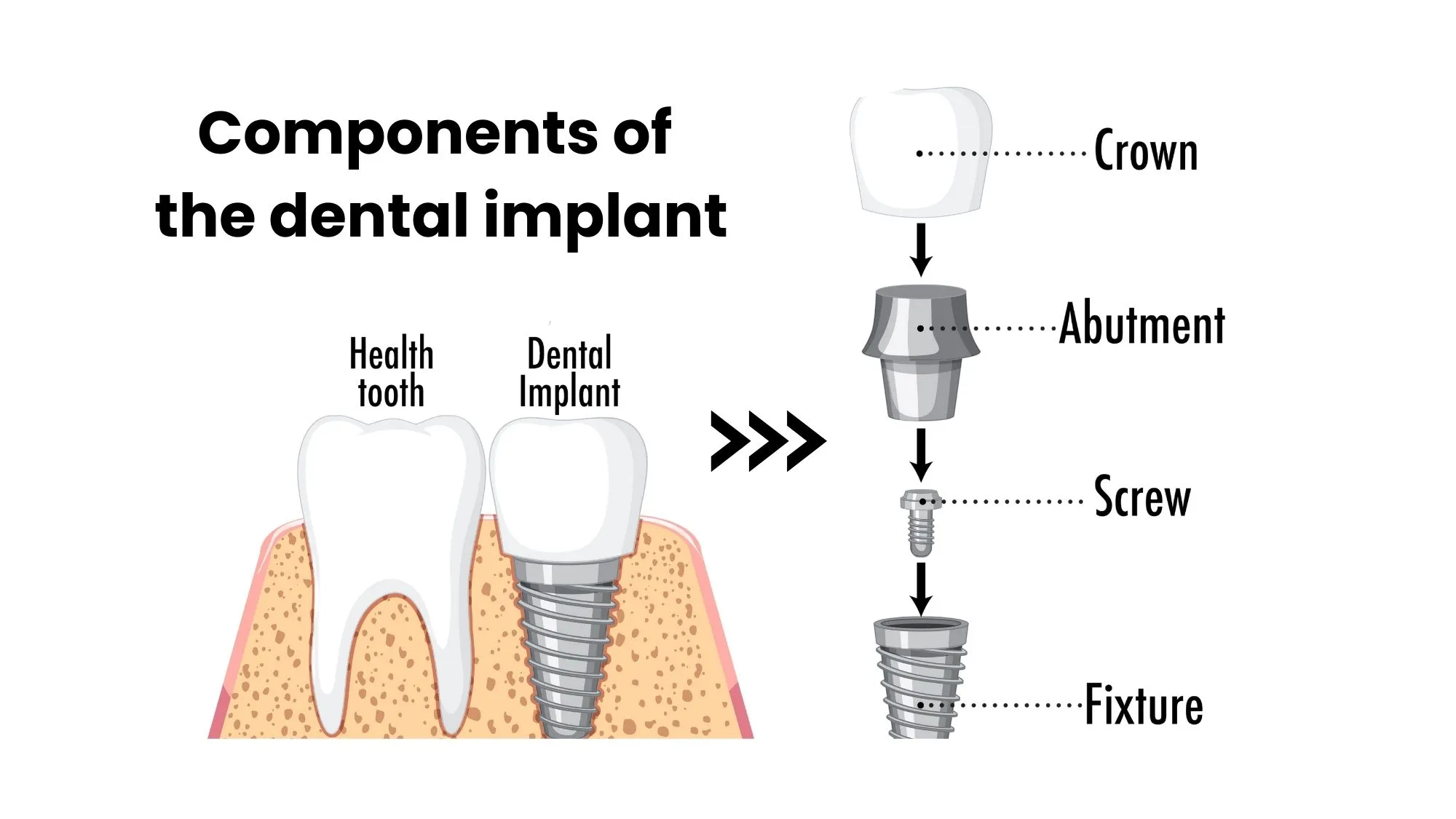 dental implants Turkey