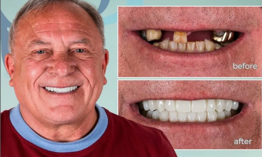All on 4 dental implants Antalya