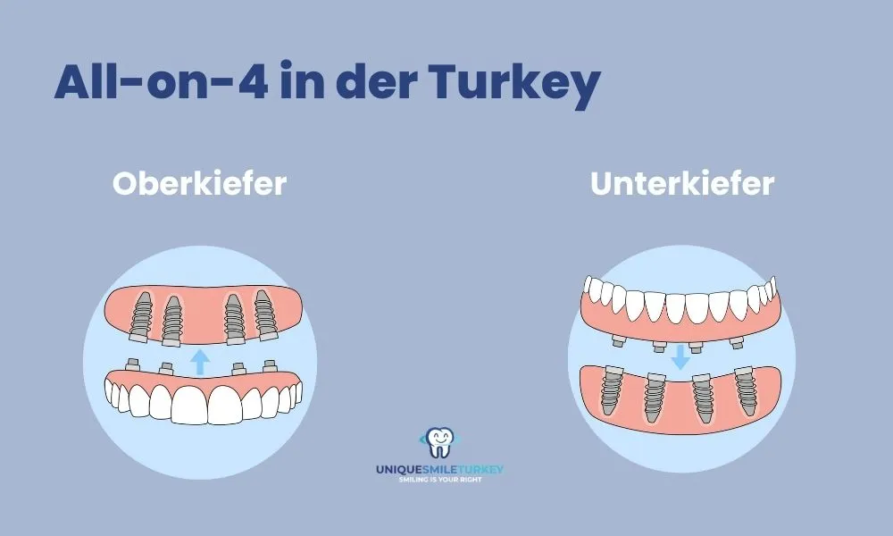All-on-4-Implantate in der Türkei