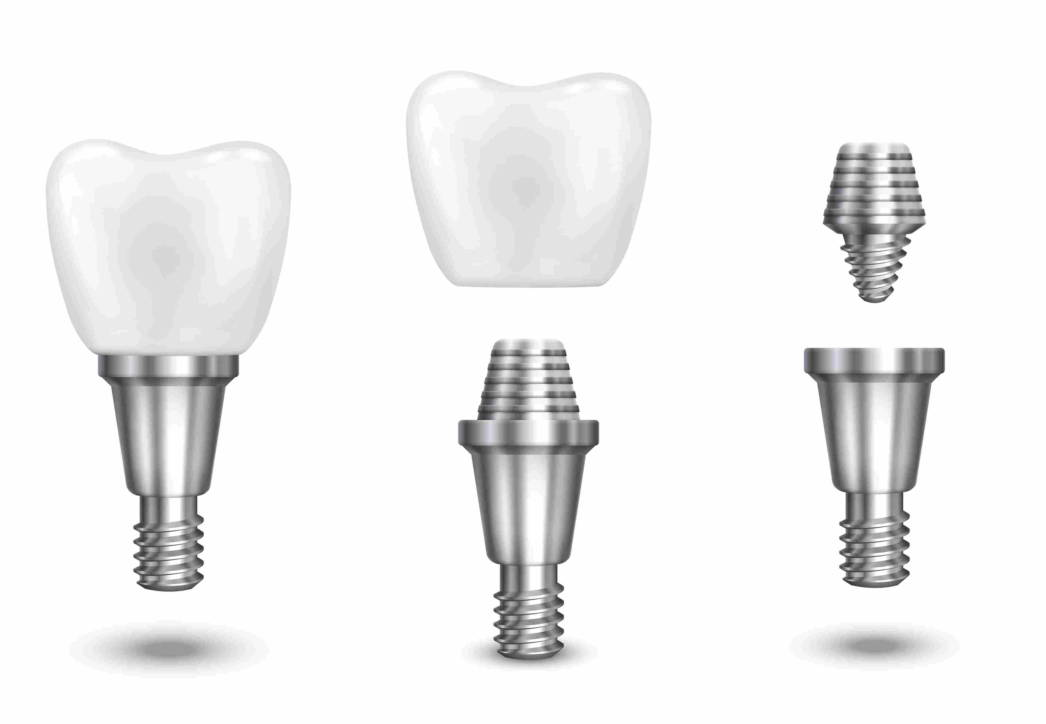All-on-four Implant