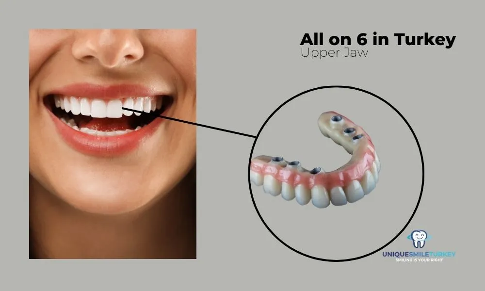 Upper jaw All on 6 dental implants Turkey