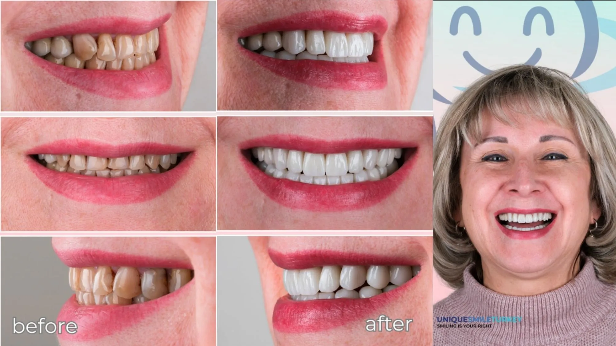 Holywood Smile in Antalya