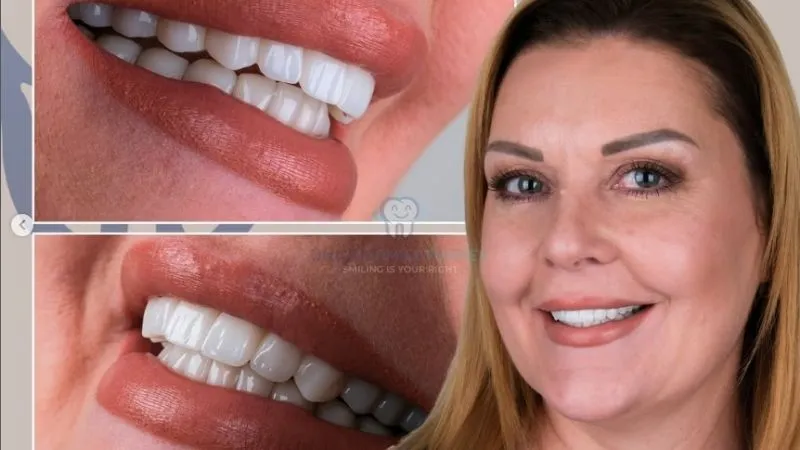 Holywood Smile Design in Antalya