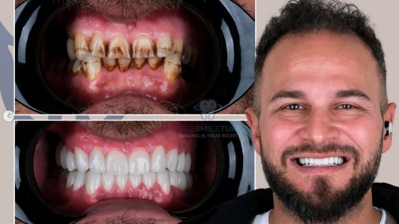 Holywood Smile Design in Antalya Turkey