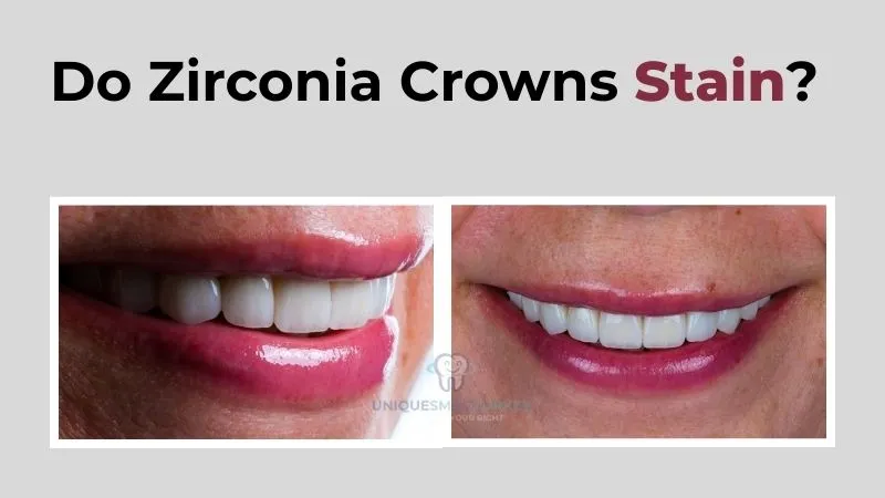 Do Zirconia Crowns Stain? in Antalya