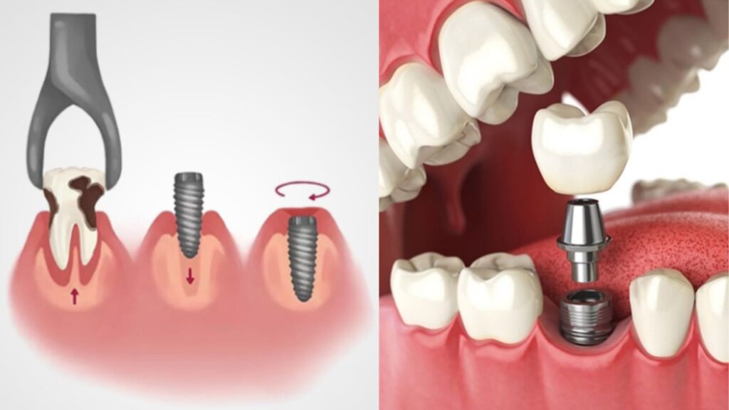 Immediate Tooth Implant After Extraction