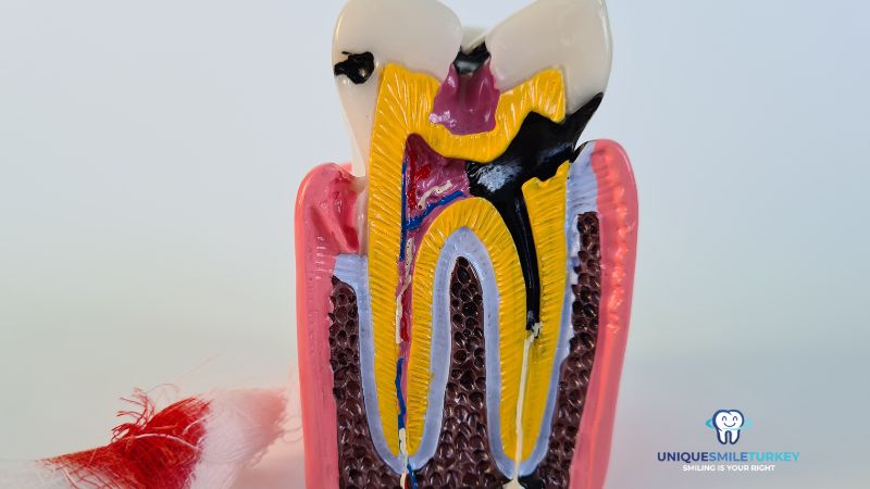 Root Canal Treatment Turkey